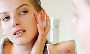 Подсказки как удалить пятна от прыщей на лице