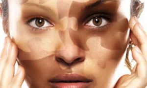 Проявление болезни витилиго?