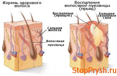 Внимание! Прыщи на голове часто приводят к выпадению волос