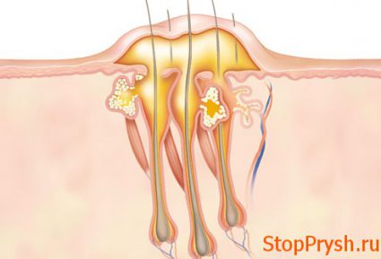 Это заболевание волосяного фоликула может образовываться из-за мелких травм кожи