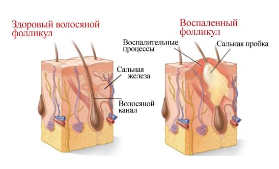 Закупорка сальной железы - основная причина прыщей!